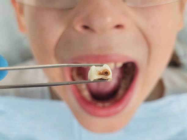 Best Emergency Broken Tooth Repair in Pine Air, FL